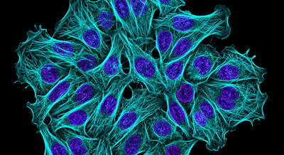 Fluorescence confocal microscopy of human adenocarcinoma cells showing cytoskeletal protein networks in cyan and violet