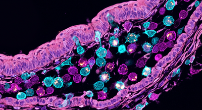 Fluorescence microscopy of immune cells infiltrating bladder urothelial tissue